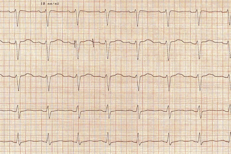 Interpreting ECG to minimise patients' risk of heart symptoms caused by long QT syndrome