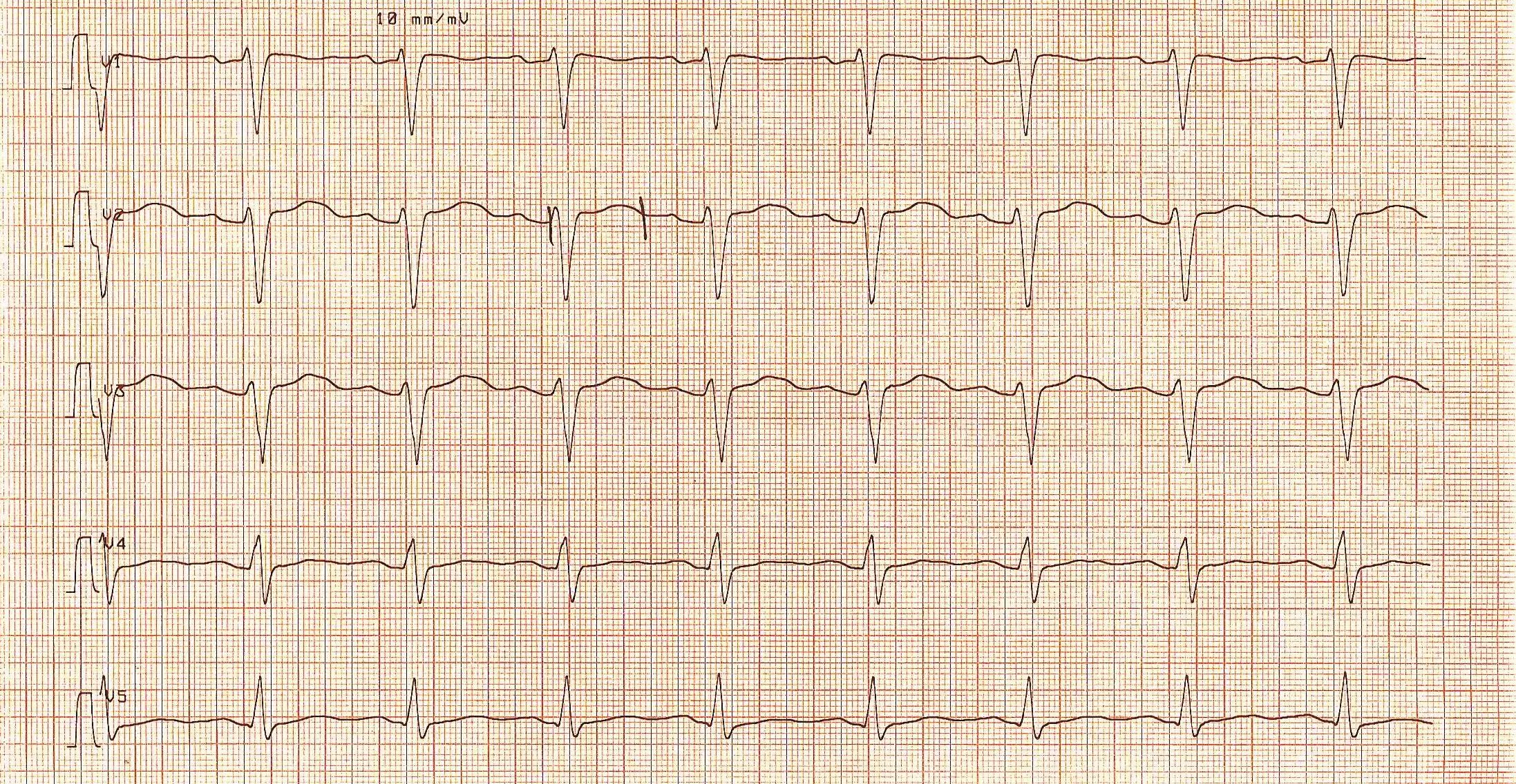 long-qt-syndrome-the-pharmaceutical-journal