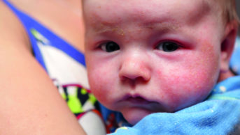 Close up of newborn baby's face with eczema