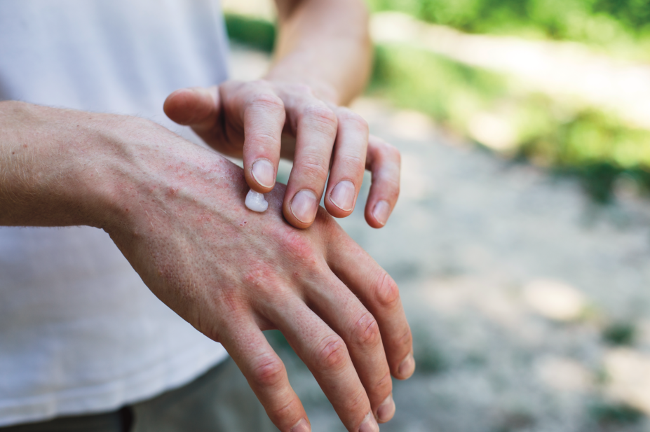 Eczema cream being applied to hands