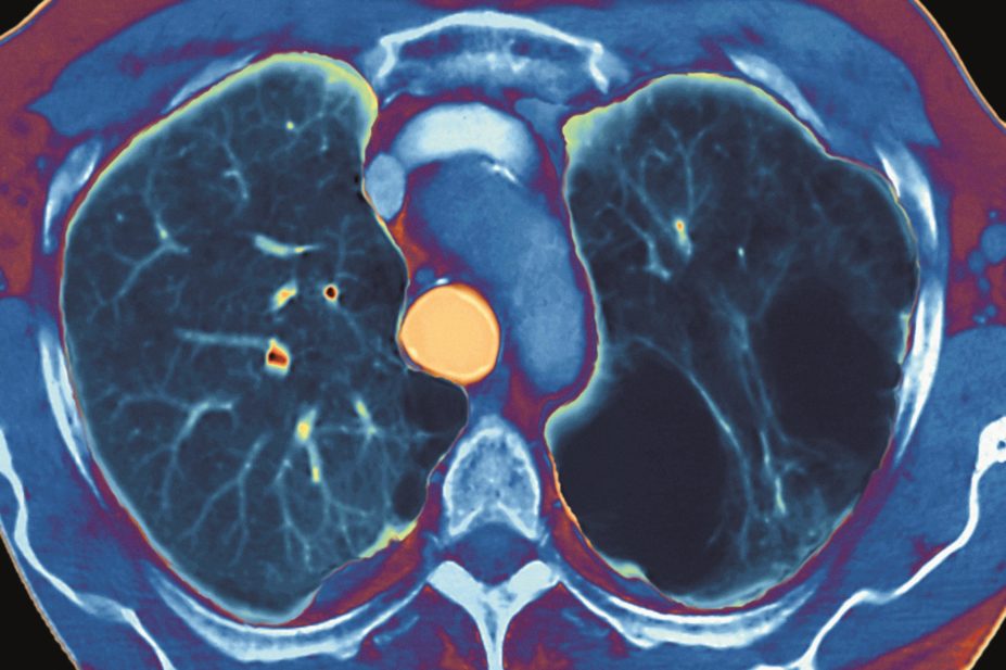 CT scan of a patient with emphysema, a type of chronic obstructive pulmonary disease (COPD). Community pharmacists can help manage patients with COPD in a cost effective way.