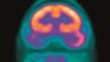 A novel peptide protects against temporal lobe epilepsy (TLE) in mouse models and could be a preventive therapy for TLE in humans. In the image, a PET scan of an epileptic brain