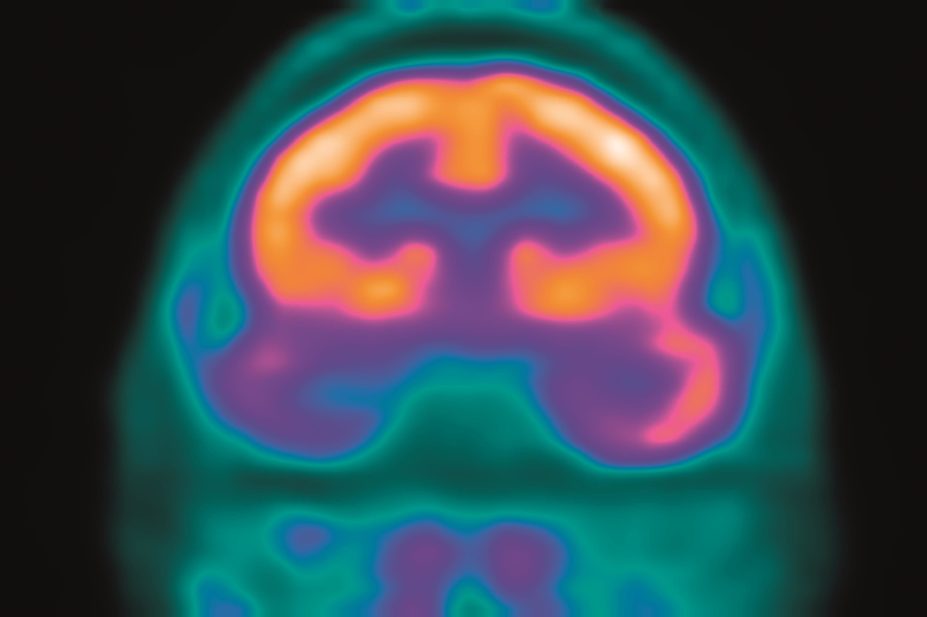 A novel peptide protects against temporal lobe epilepsy (TLE) in mouse models and could be a preventive therapy for TLE in humans. In the image, a PET scan of an epileptic brain