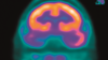 PET scan of an epileptic brain