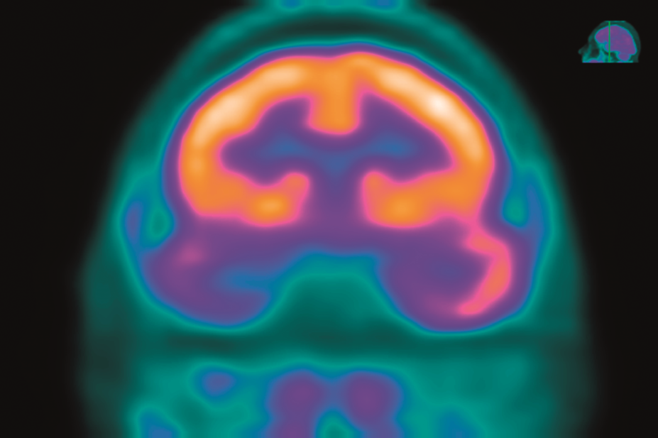 PET scan of an epileptic brain
