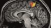 fMRI brain scan image