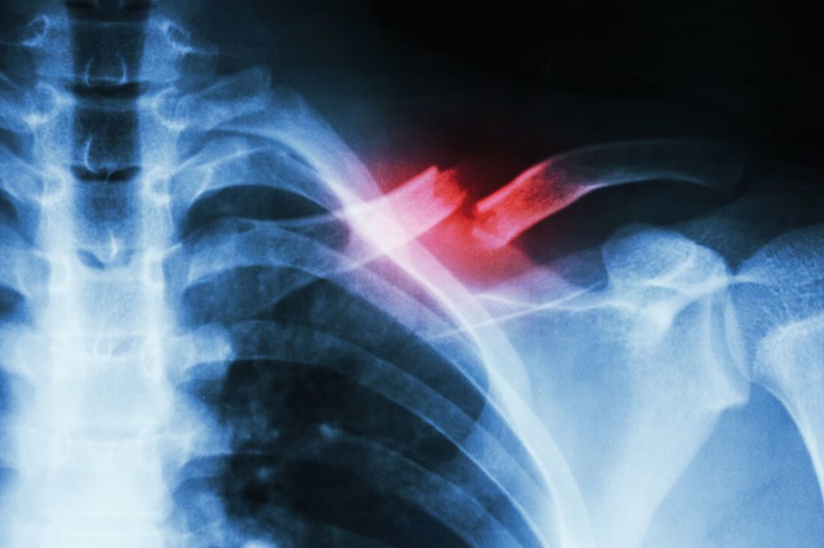 Xray showing fracture of middle bone clavicle