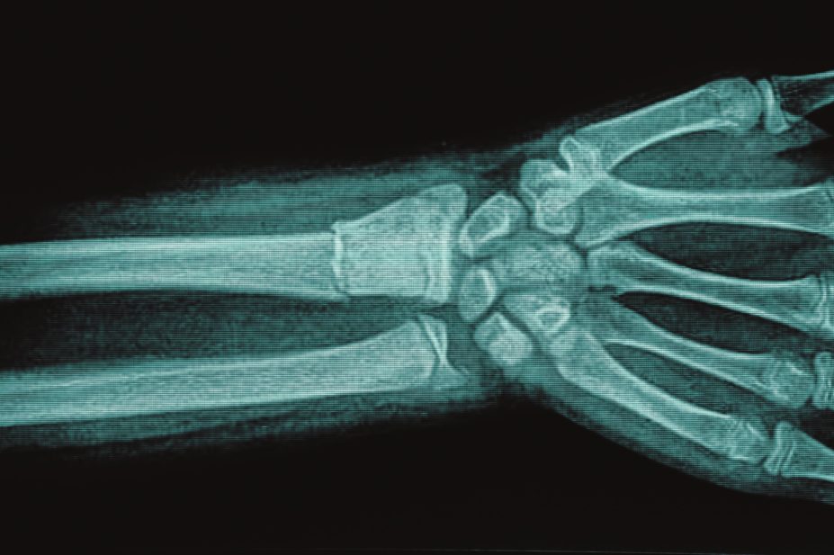 Proton pump inhibitors (PPIs) are associated with an increased risk of bone fracture, but the underlying mechanisms are poorly understood. In the image, x-ray of a fractured wrist