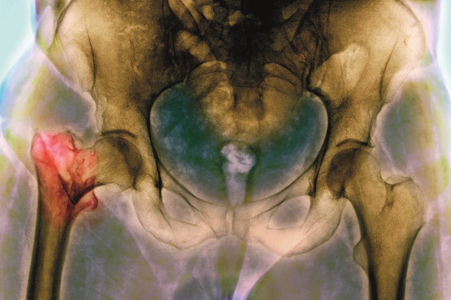 Fractured osteoporotic hip of an elderly woman after a fall. Around one in three people aged over 65 years falls at least once a year. This increases to around 50% of people older than 75 years