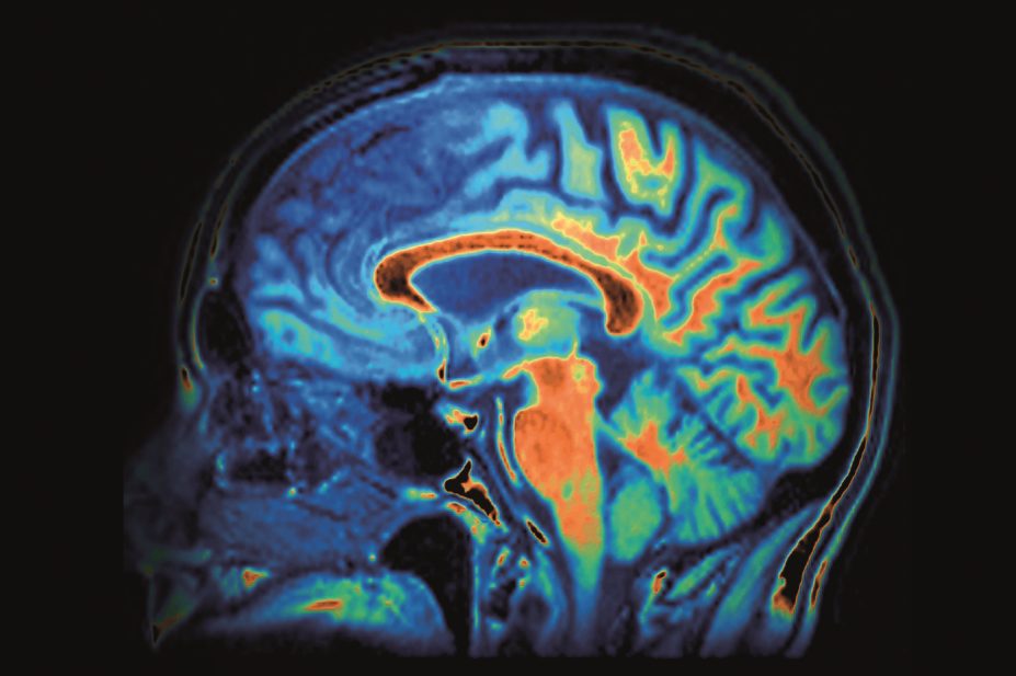 In a new study of 3,434 people aged 65 and over, researchers found no increased risk of dementia or cognitive decline among those who had the highest levels of benzodiazepine use. In the image, MRI scan of a person with dementia