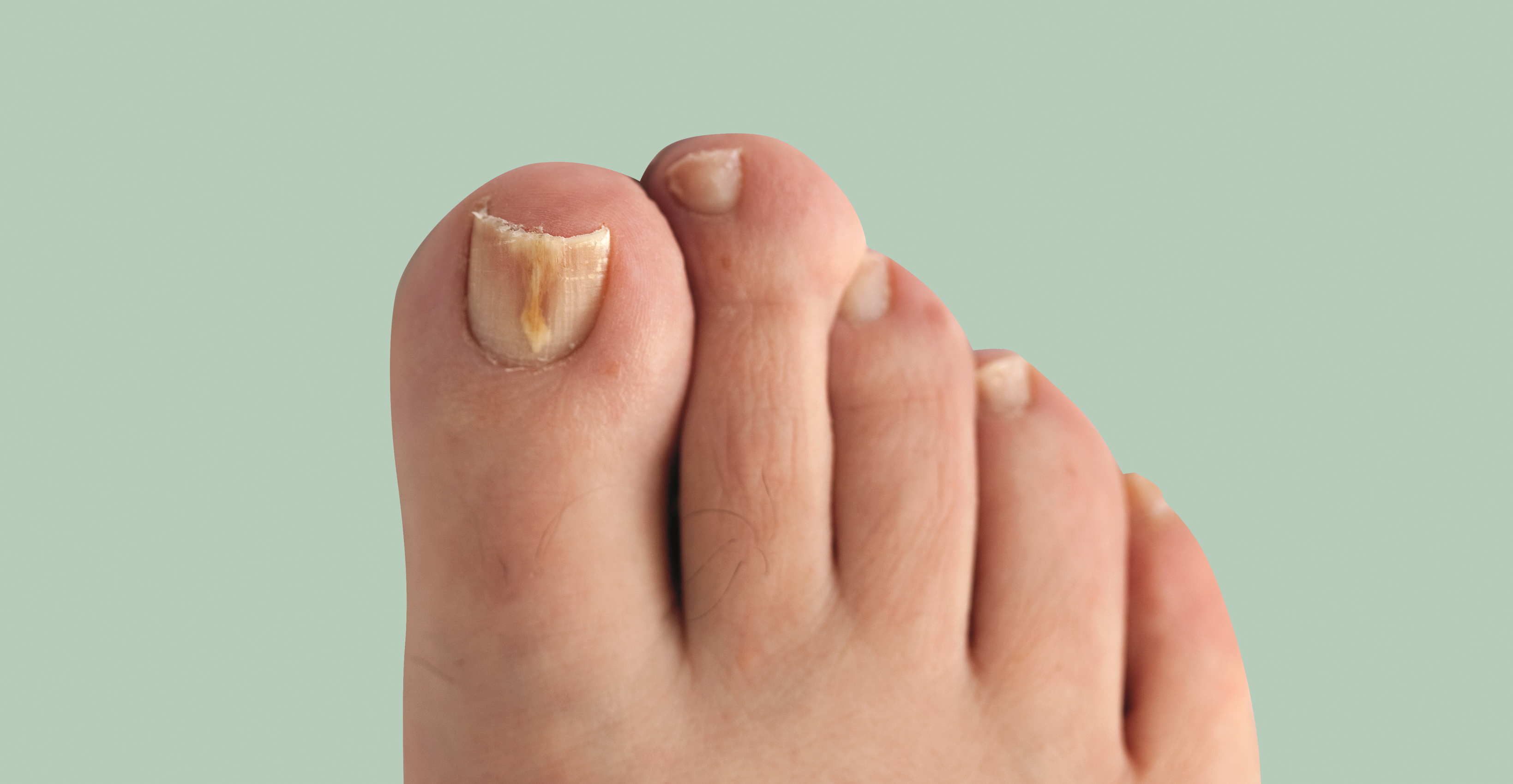 How long does it take for toe fungus to heal Toenail Fungus Pictures Of What It Looks Like Treatment Tips