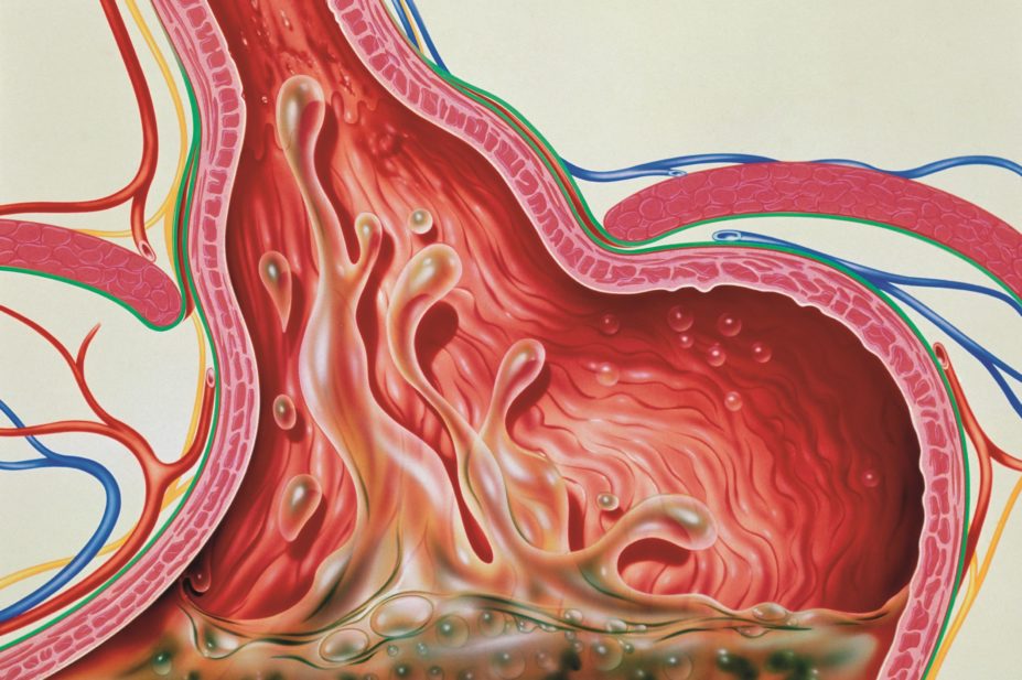 Illustration of gastro-oesophageal reflux