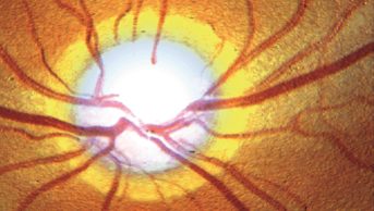 Glaucoma is a group of optic neuropathies characterised by progressive degeneration of retinal ganglion cells. This degeneration results in cupping of the optic disc and visual loss