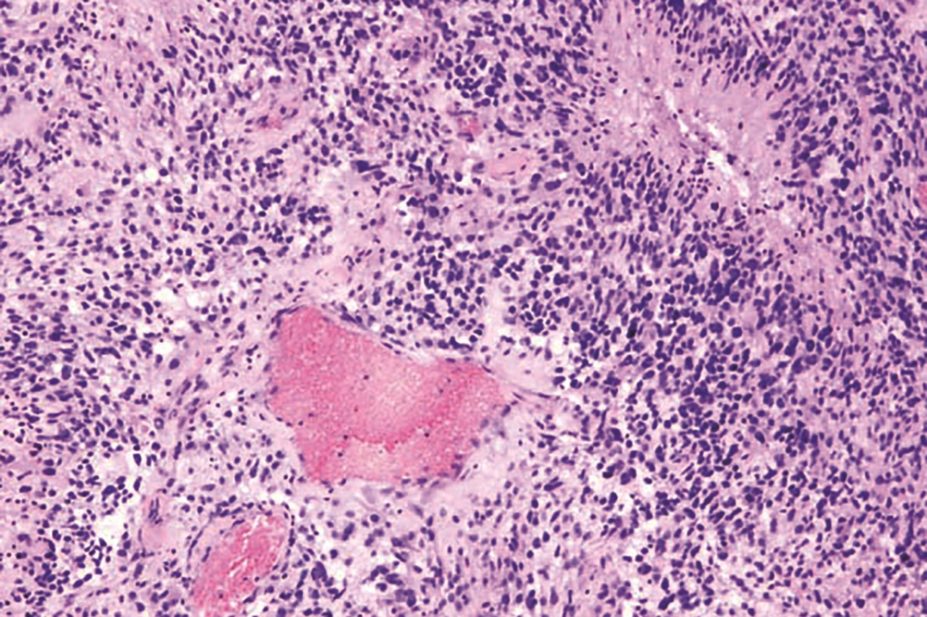 Immune checkpoint inhibitors could play a role in patients with glioblastoma (pictured) and brain metastases, study finds