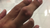 gout finger