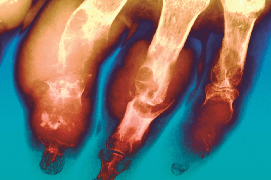 Coloured X-ray of the fingers of a patient with gout