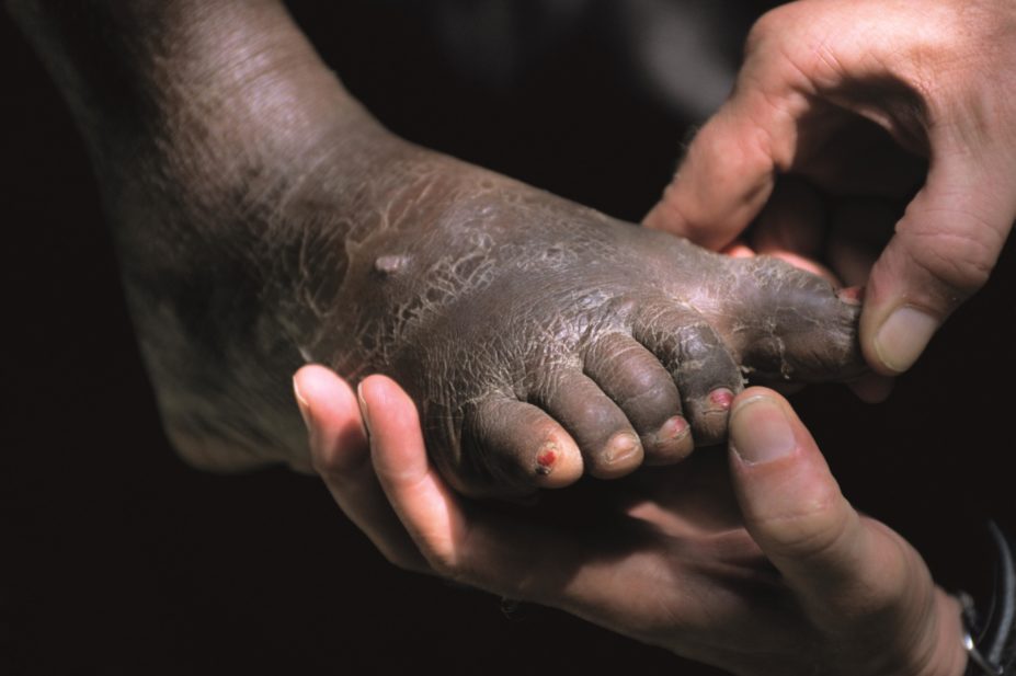 Haitian patient suffering from lymphatic filariasis, classified by WHO as a neglected tropical disease