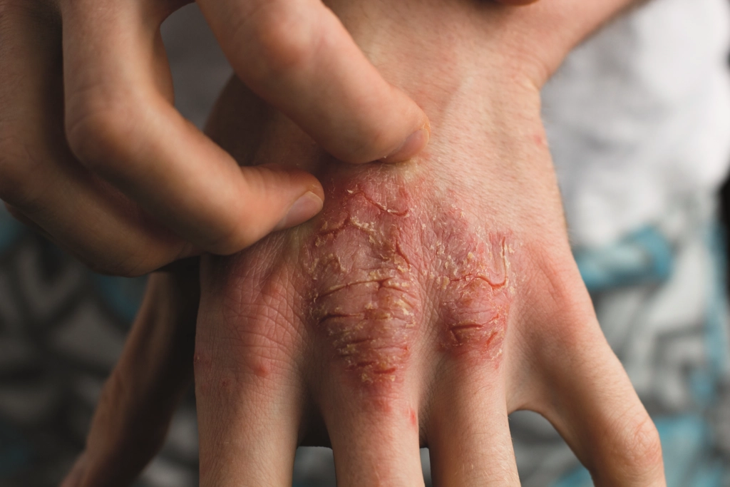 Research Identifies Potential Target For Treating Inflammatory Skin Diseases The Pharmaceutical Journal