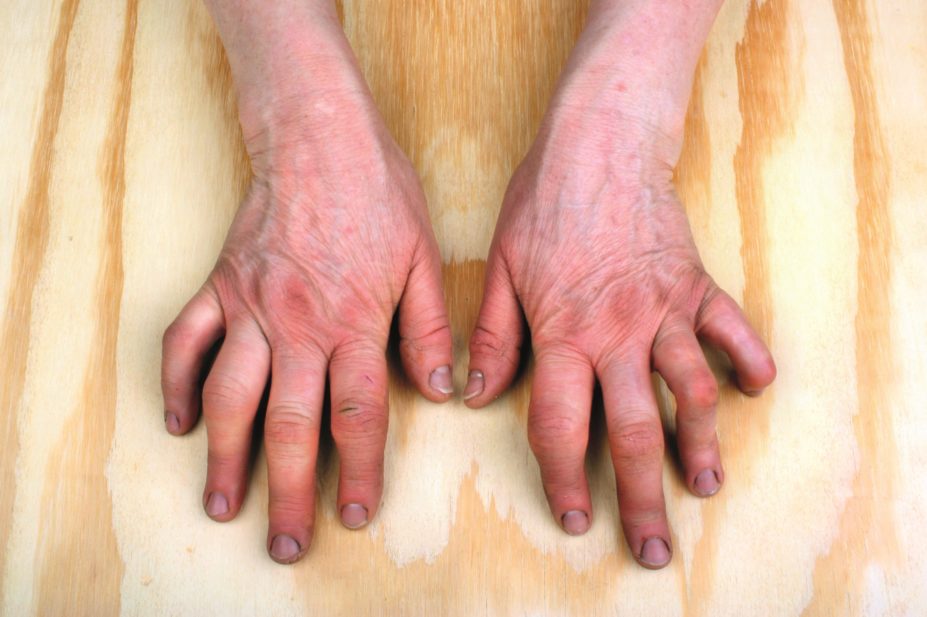 Close up of hands with rheumatoid arthritis