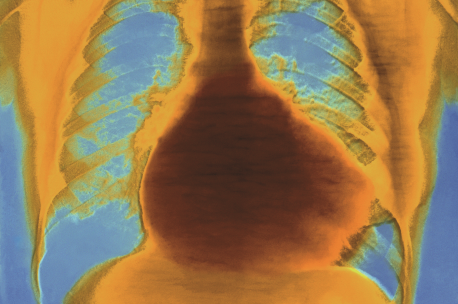 Heart disease, x-ray showing enlarged heart