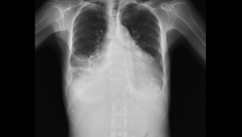 Heart x-ray