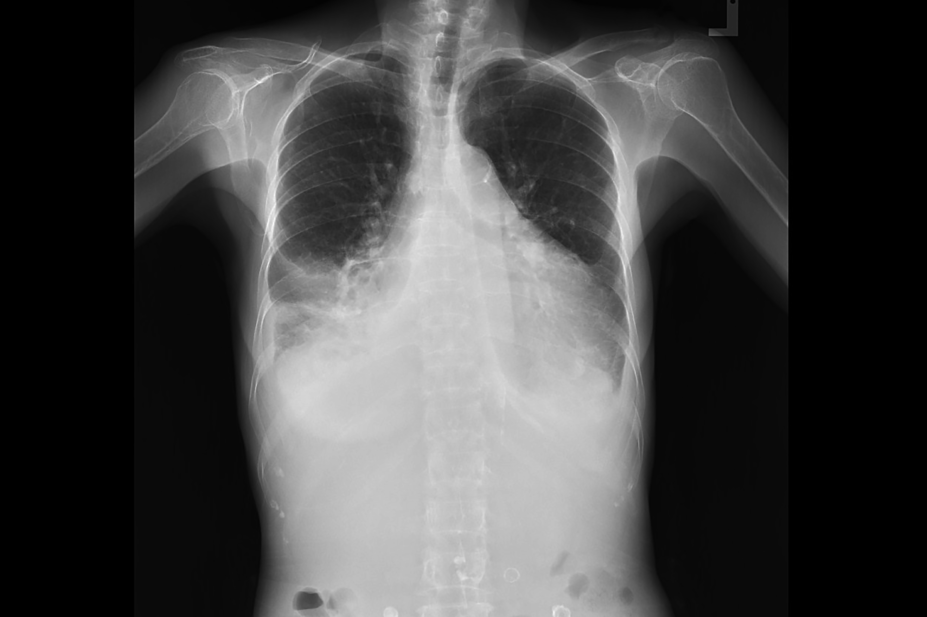 Heart x-ray