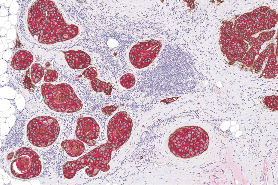 Micrograph of HER2-positive breast cancer