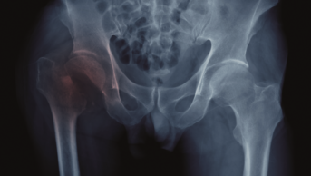 X-ray of hip fracture