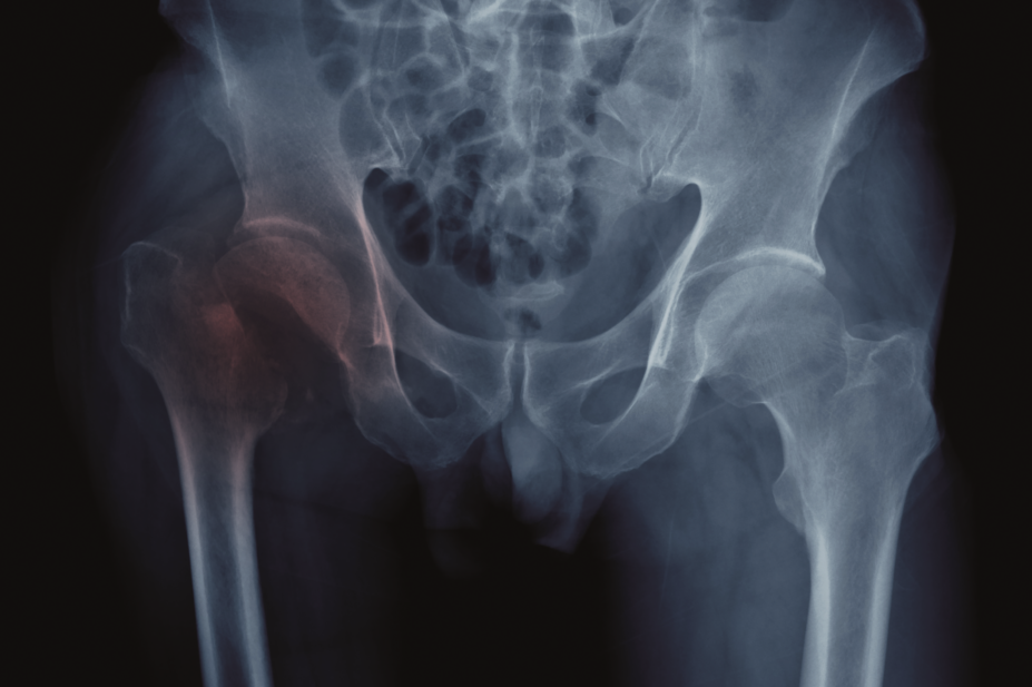 X-ray of hip fracture
