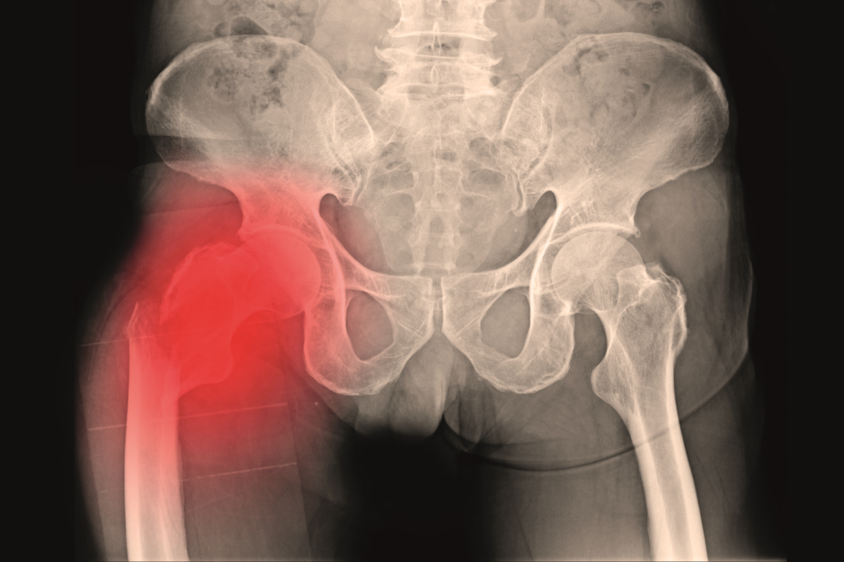 X-ray showing hip fracture