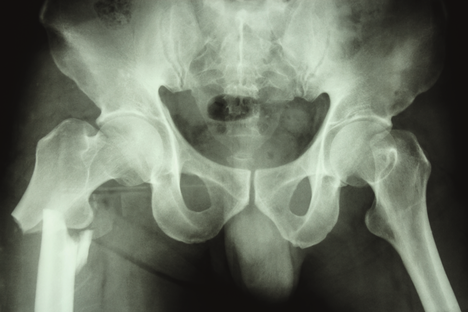 Xray of a hip fracture