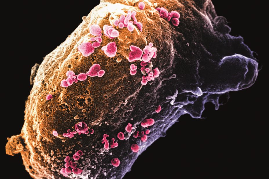 Scanning electron micrograph (SEM) of a lymphocyte with HIV cluster