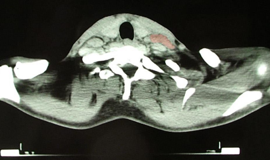 Hodgkin’s lymphoma therapy improves survival in hard-to-treat cases. CT image of 46 year old patient with Hodgkin's lymphoma, image at neck height