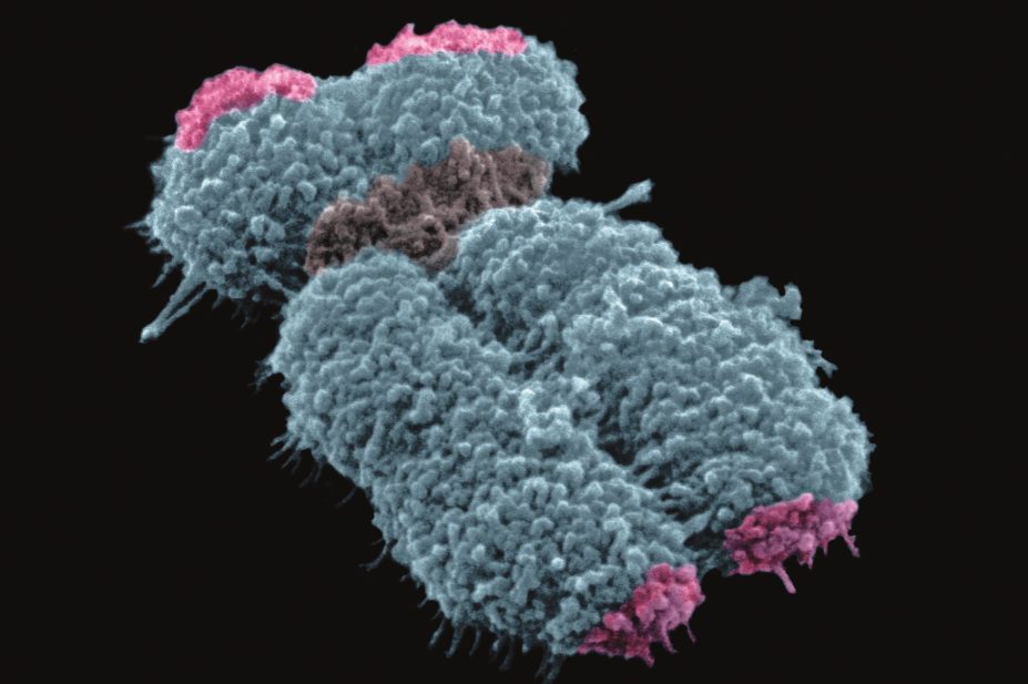 Human cancers use the alternative lengthening of telomeres (ALT) pathway in order to overcome cell death. This could be used as potential treatment for vulnerable tumours. In the image, human chromosome with telomeres (in pink).