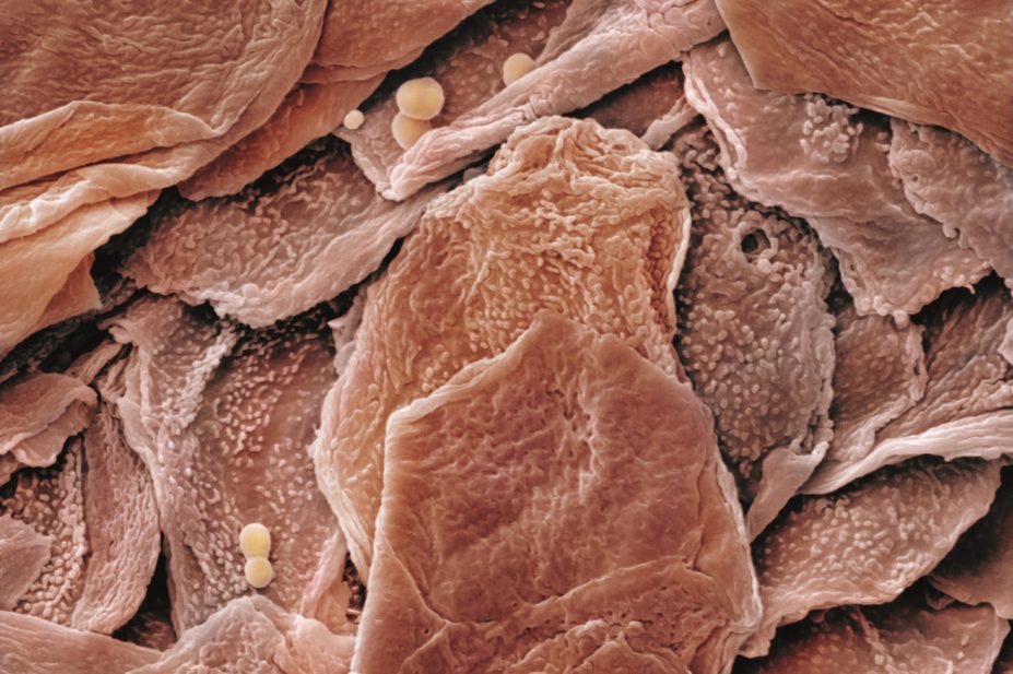Turning skin cells into pancreatic beta cells could help treat diabetes. In the image, scanning electron micrograph of human skin cells