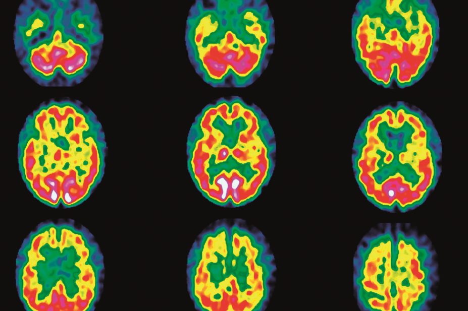 The fatty acid food supplement triheptanoin oil could improve brain energy in Huntington disease, study finds. In picture, scan of brain with Huntington disease
