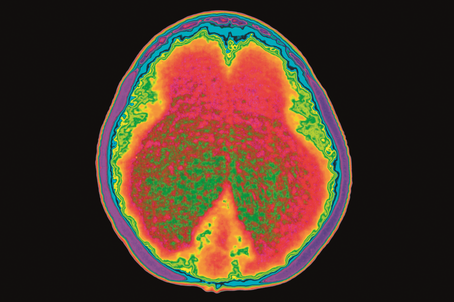 CT scan of brain suffering from hydrocephalus