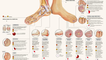 Infographic showing common foot conditions