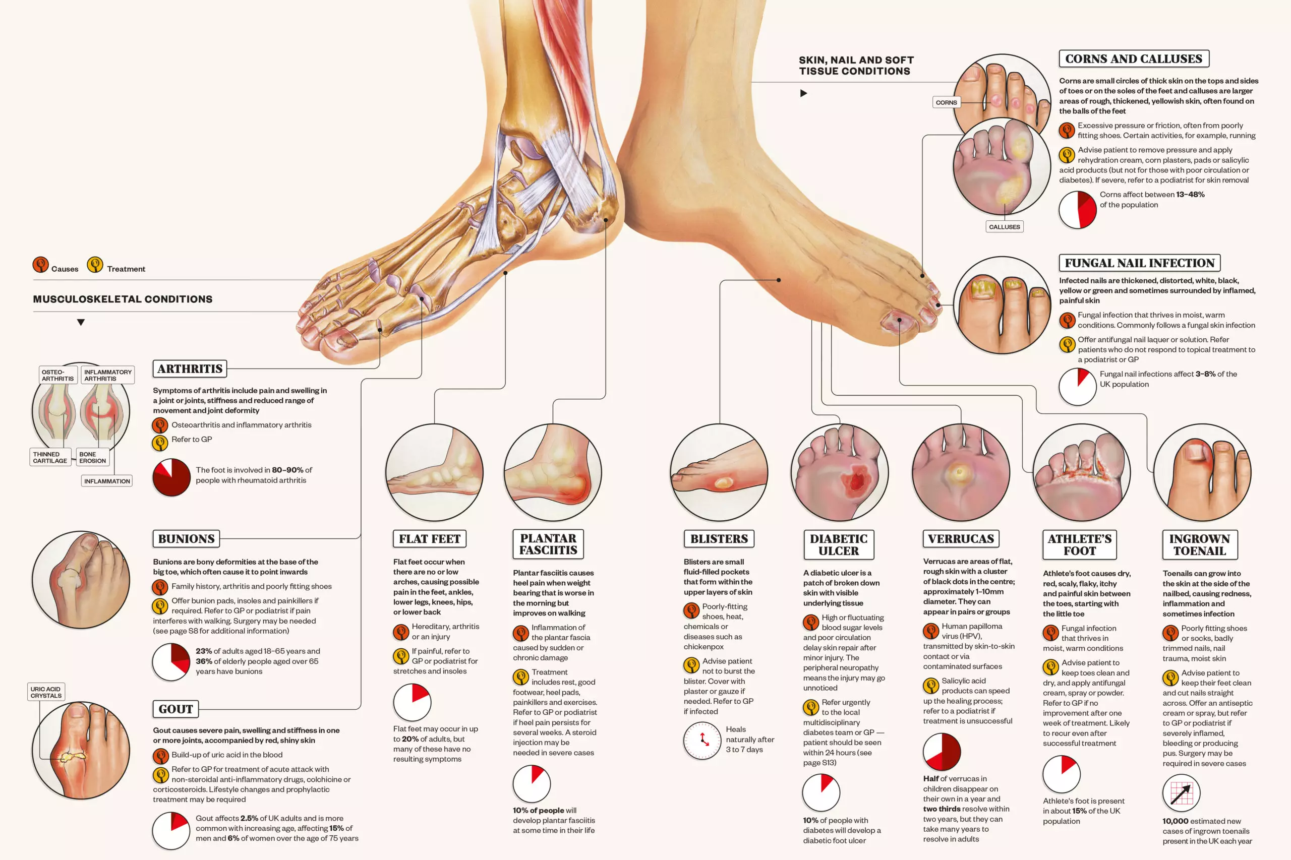 z foot deformity