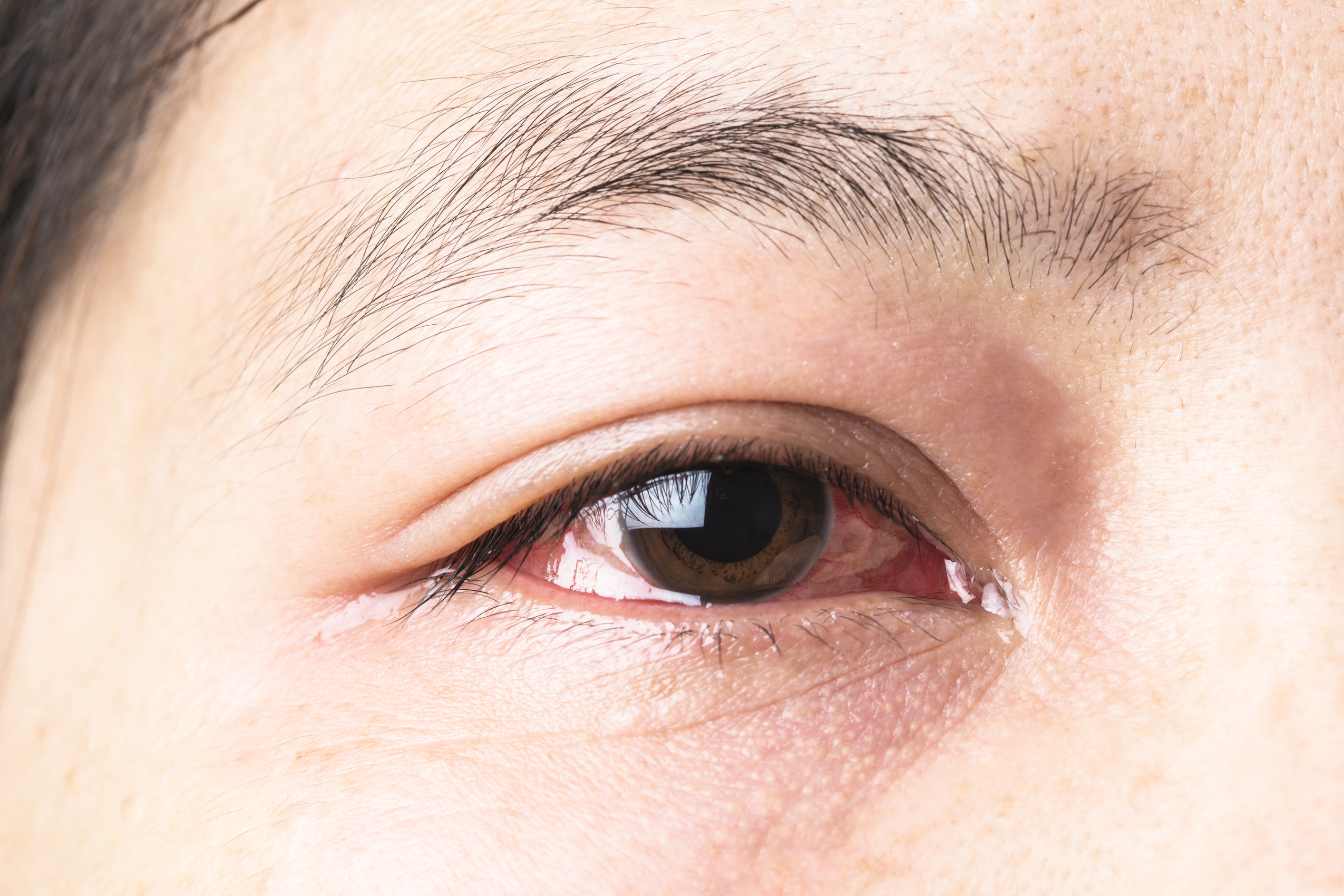 Common Eye Problems - Baptist Health