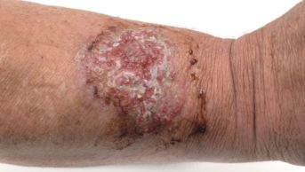 Infected ulcer in the forearm of a male patient