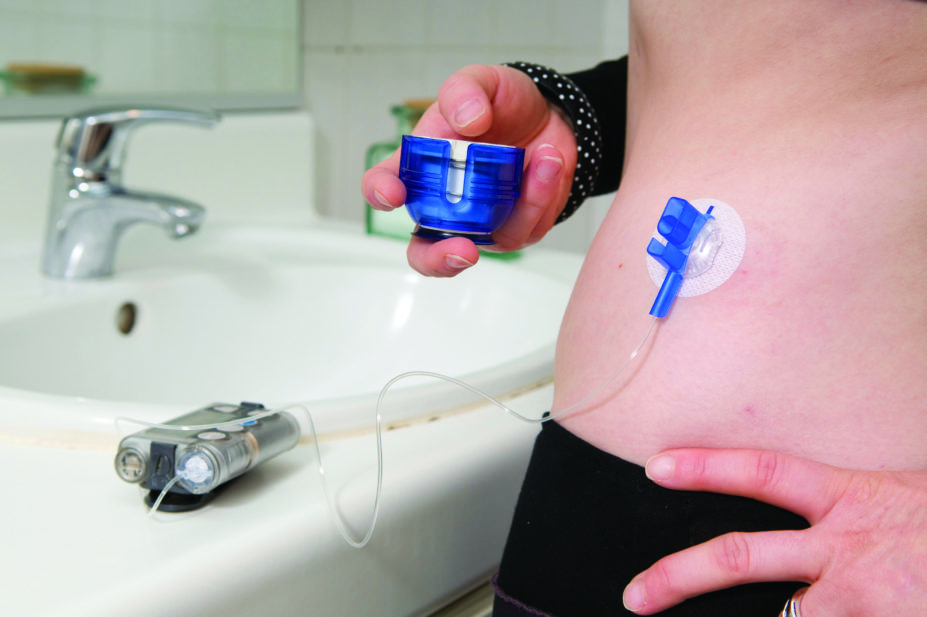 Insulin pump on young girl