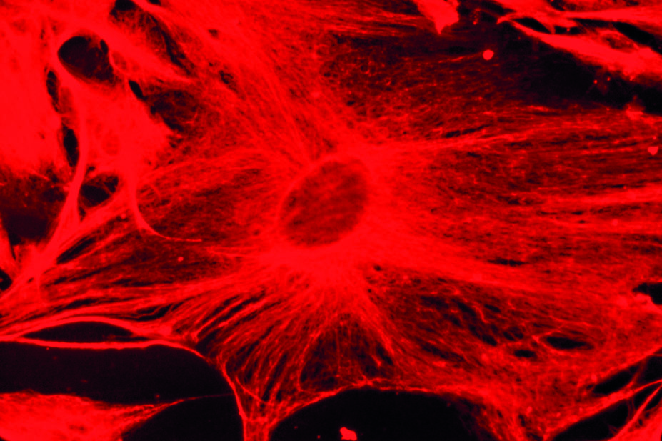 Fluorescence light micrograph of a neuroblastoma cell (brain cancer cell) showing neurofilaments (intermediate filament protein)