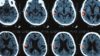 Scans of intracerebral hermorrhage
