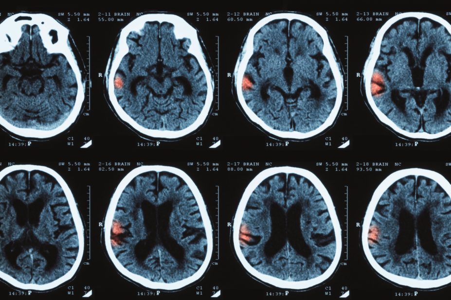 Scans of intracerebral hermorrhage