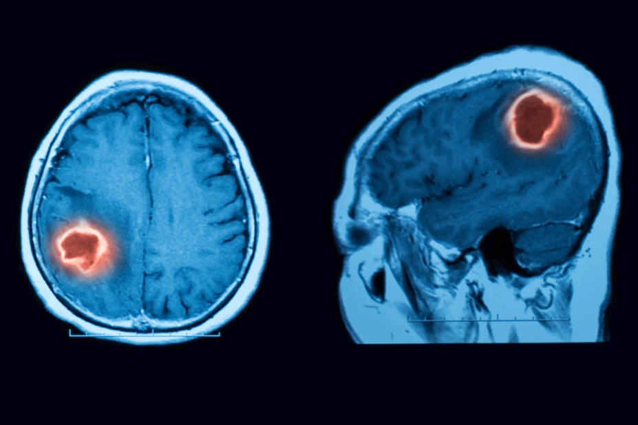 MRI showing intracerebral haemorrhage