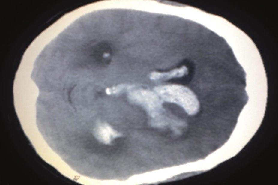 Concomitant use of antidepressants and non-steroidal anti-inflammatory drugs (NSAIDs) is associated with a significantly increased risk of intracranial haemorrhage (ICH). In the image, axial CT scan of intracranial haemorrhage