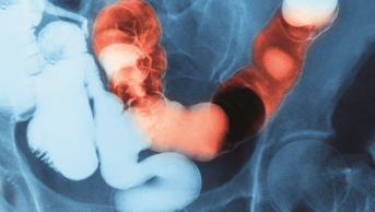 Fluoroscopic examination of gastrointestinal (GI) tract showing inflammatory bowel disease (IBD)