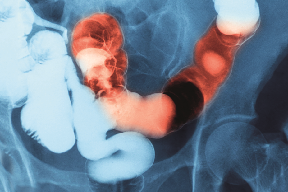 Fluoroscopic examination of gastrointestinal (GI) tract showing inflammatory bowel disease (IBD)
