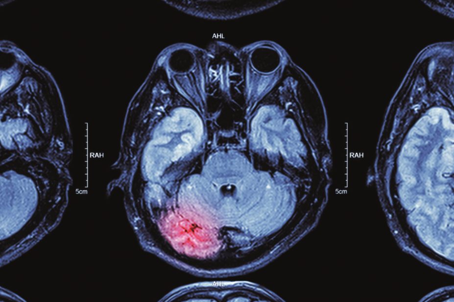 The Medicines and Healthcare products Regulatory Agency (MHRA) has backed the continued use of the thrombolytic drug alteplase for up to 4.5 hours after the onset of symptoms of acute ischaemic stroke. In the image, MRI scan of a brain with stroke